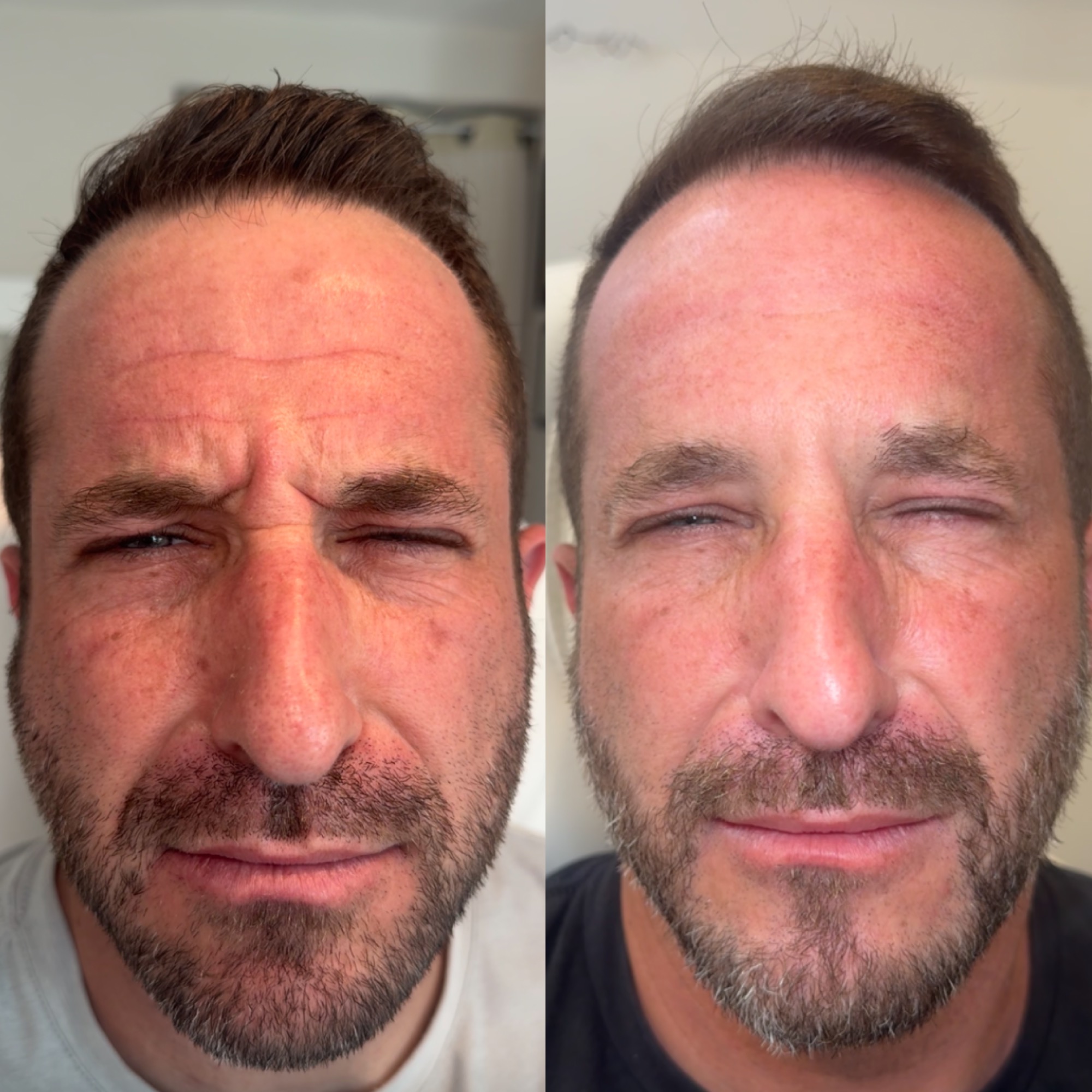 Botox & Daxxify in Clearwater FL