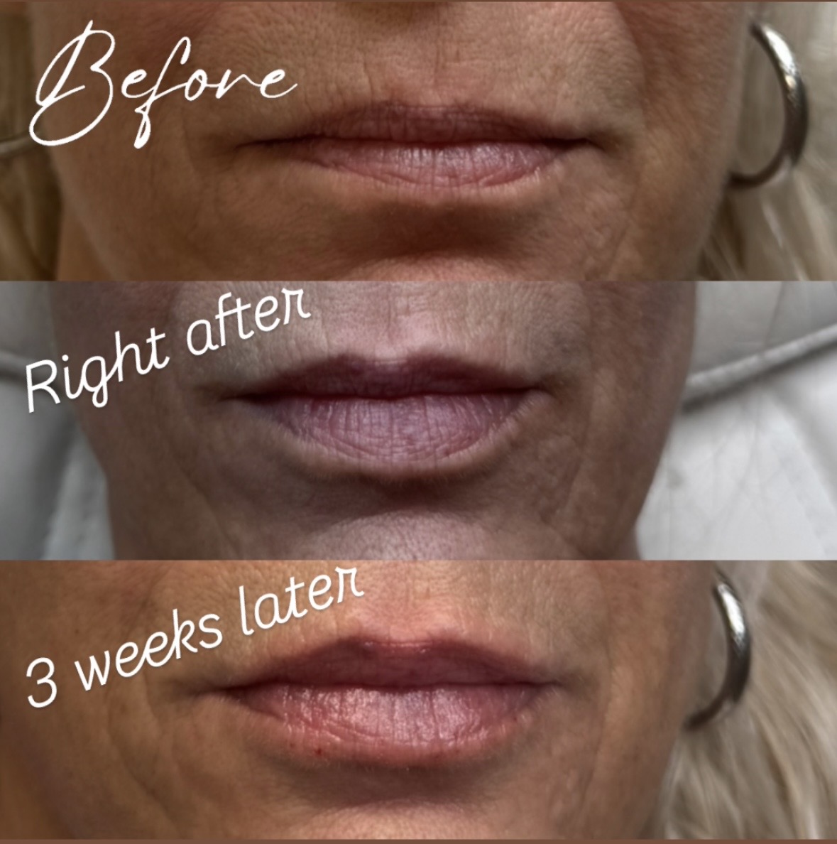 Lip Fillers & Facial Contouring in Clearwater FL